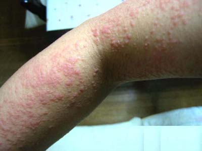 湿疹的症状发病原因及治疗方法